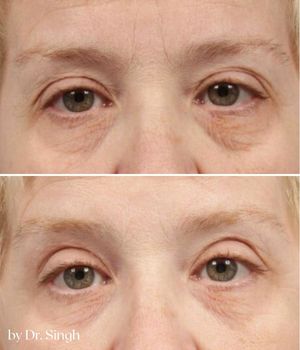 before after blepharoplasty nyc